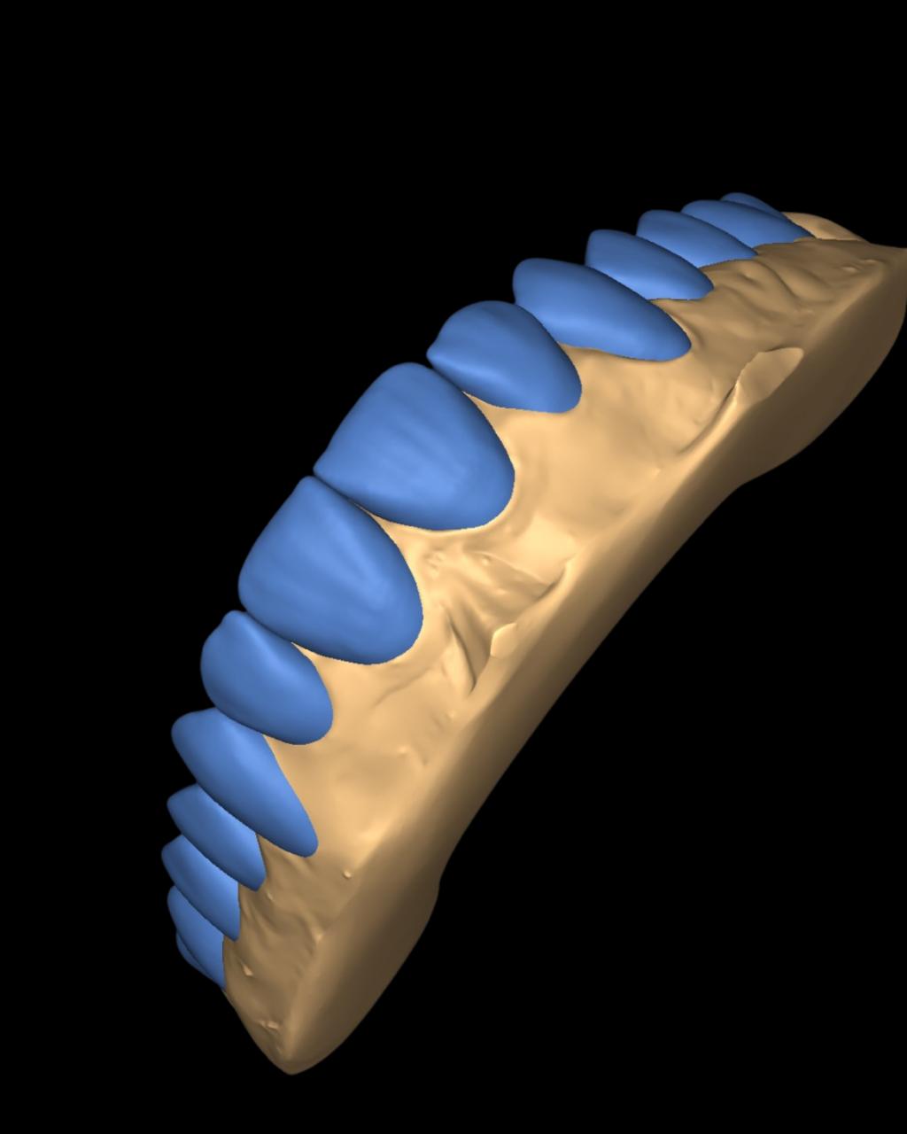 Enceramento diagnóstico digital no Exocad - MagnoDentalCad