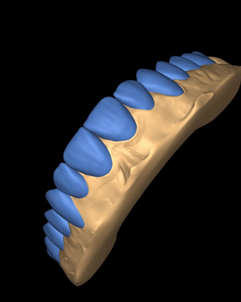 Enceramento diagnóstico digital no Exocad - MagnoDentalCad