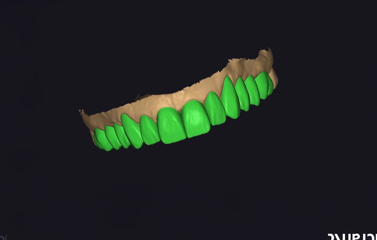 Enceramento diagnóstico digital - arcada anterior no Exocad