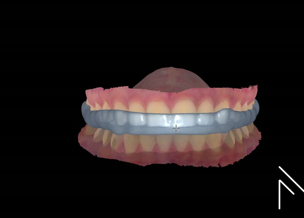 Design de placa de bruxismo no Exocad - MagnoDentalCad