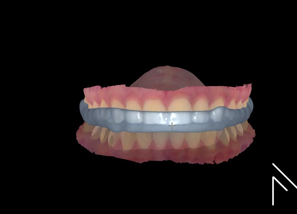 Design de placa de bruxismo no Exocad - MagnoDentalCad